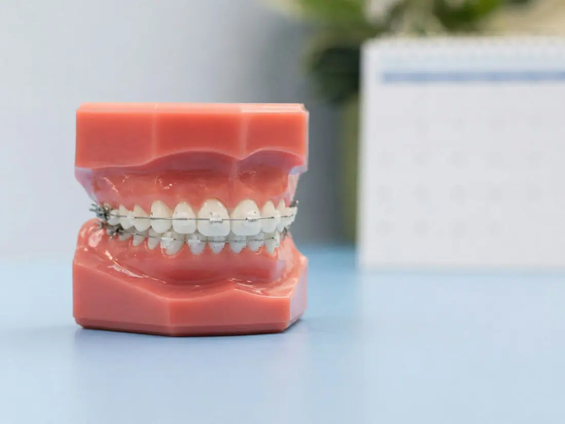Modelos dentales con aparatología de ortodoncia