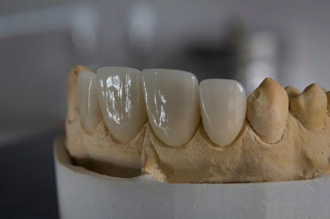 Coronas de cerámica sobre modelo