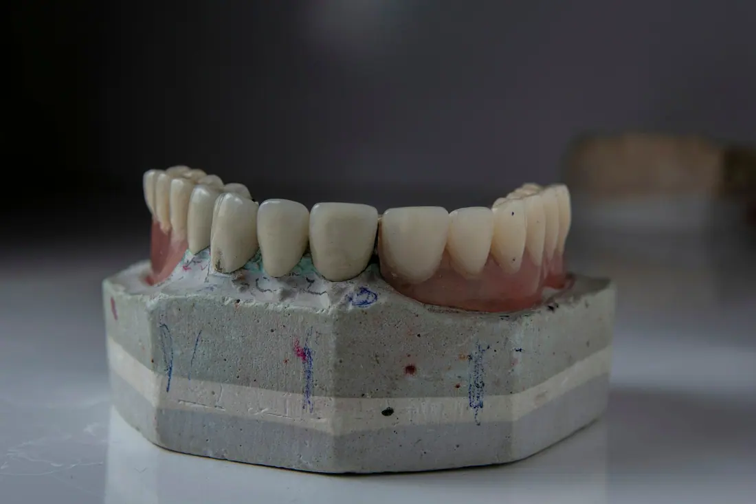 Puente dental de arcada completa sobre modelo